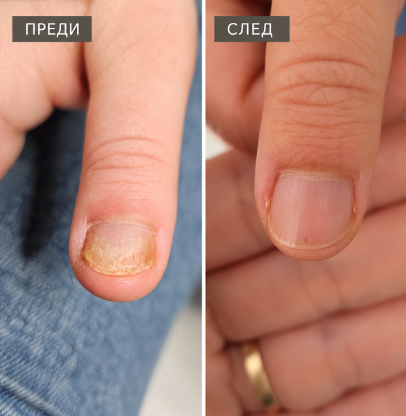 Терапевтичен педикюр