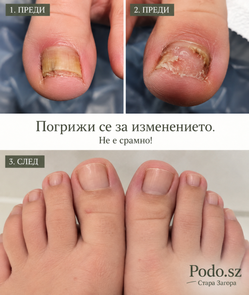 Терапевтичен педикюр